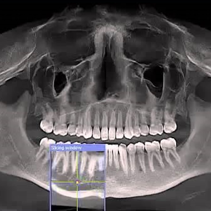 Rimozioni cisti dentali