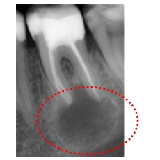 Rimozioni cisti dentali